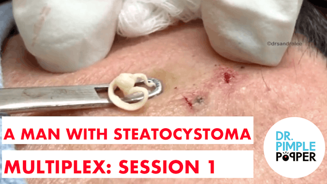 A Man with Steatocystoma Multiplex: S...
