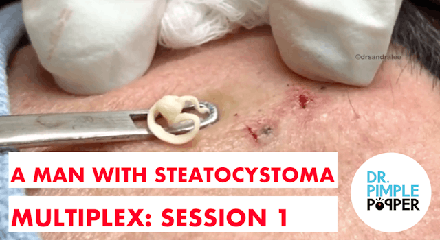 A Man with Steatocystoma Multiplex: Session 1