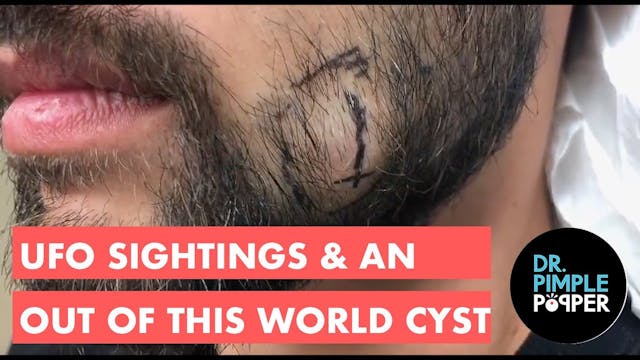 UFO Sightings: An Out of This World Cyst