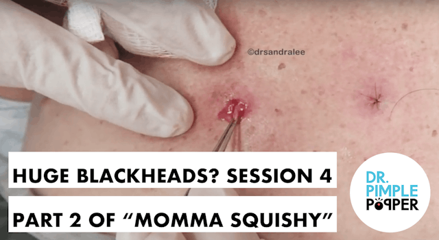 WEB EXCLUSIVE SNEAK PEEK: Huge Blackheads? Session 4, Part Two of "Momma Squishy"