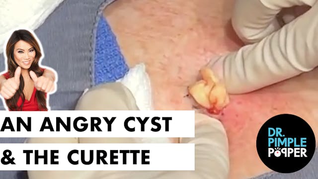 A Very Angry Cyst Meets the Curette! 