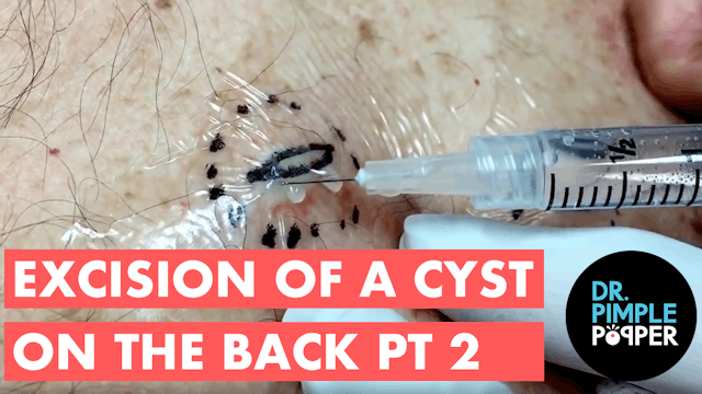 Excision of cyst on back: Part II of II. For medical education- NSFE.