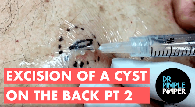 Excision of cyst on back: Part II of ...