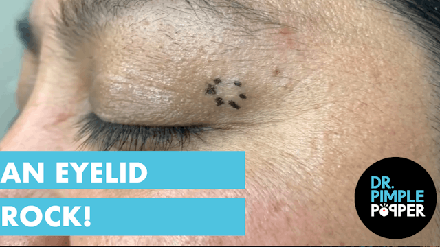 An Eyelid ROCK