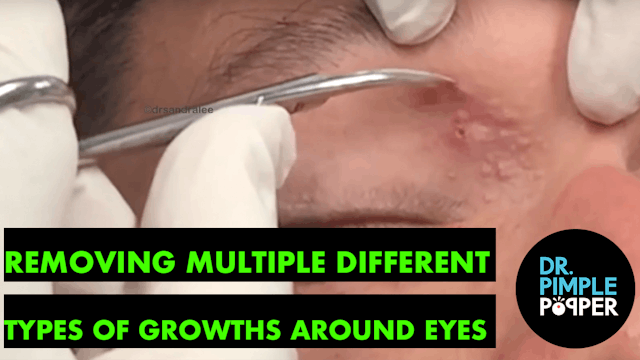 Removing Different Types of Growths