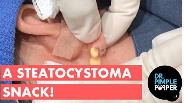 A Steatocystoma Snack!