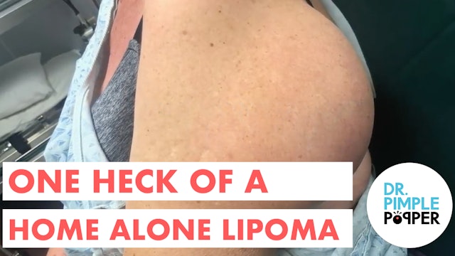 One Heck of a Home Alone Lipoma 