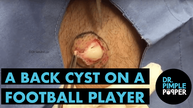 A Back Cyst on a Football Player