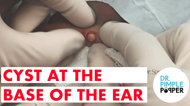 Cyst at the Base of the Ear