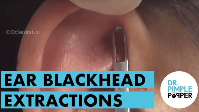 Ear Extractions