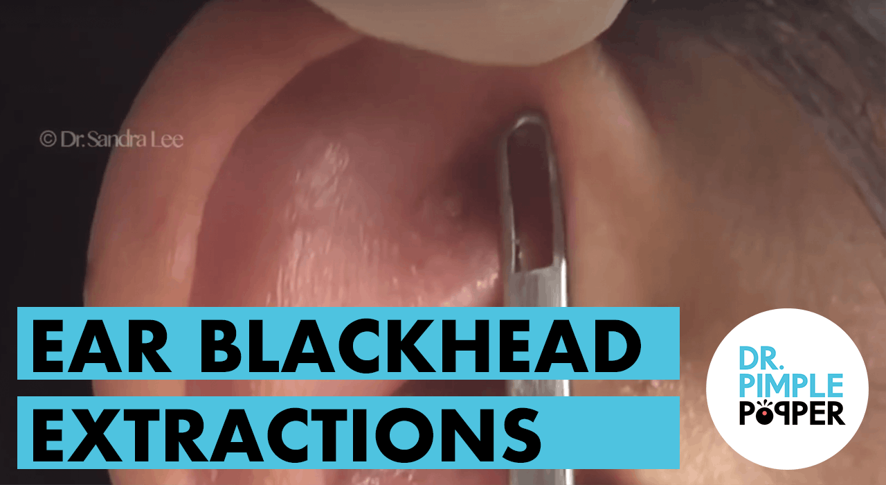 Ear Extractions Blackheads & Whiteheads Galore Dr. Pimple Popper