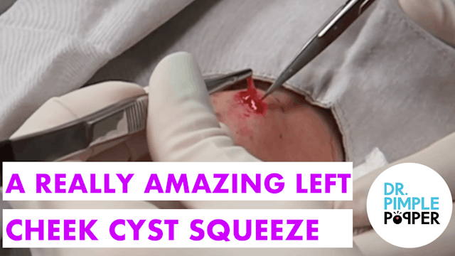An Amazing Cyst Squeeze