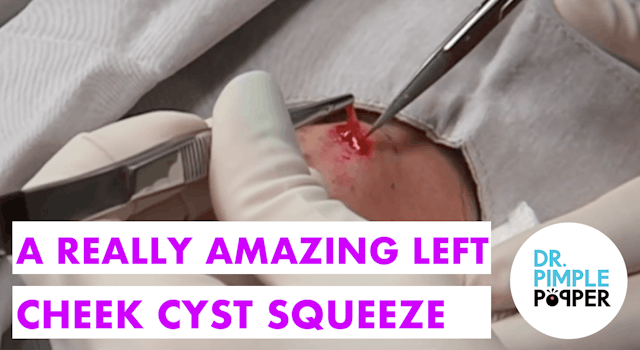 An Amazing Cyst Squeeze