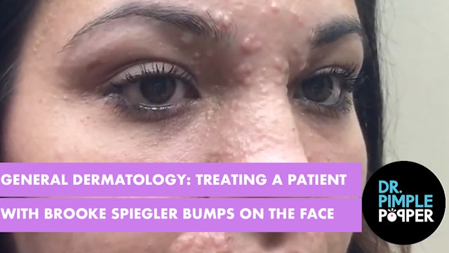 General Dermatology - treating a patient with Brooke Spiegler syndrome, bumps on the face