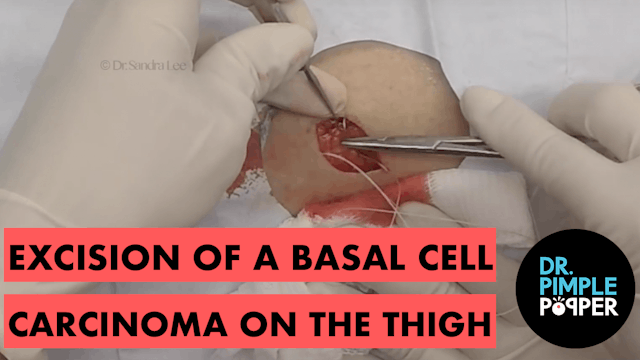 Excision of a Basa Cell Carcinoma on the Thigh