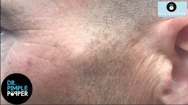 Grapes Growing Out of Head! Dr Pimple Popper Pops Face Cluster