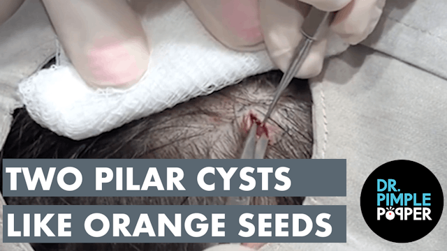 Two Pilar Cysts Like Orange Seeds