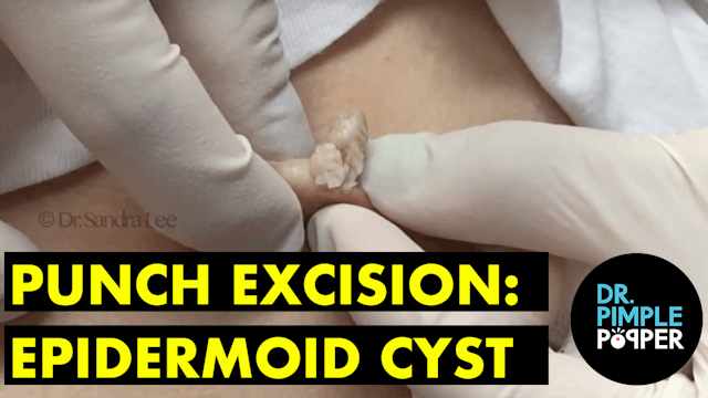 Punch excision, left flank: Epidermoi...