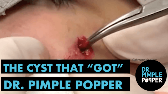 The Cyst that "GOT" Dr Pimple Popper!