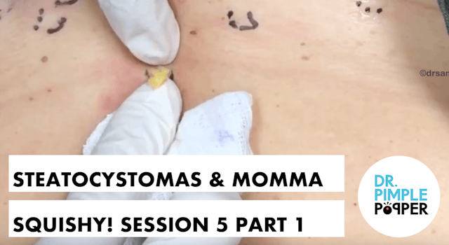 Steatocystomas & Momma Squishy! Session Five, Part 1