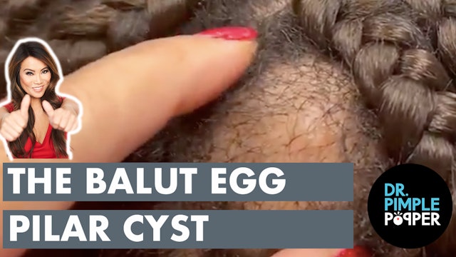 The Balut Egg Pilar Cyst