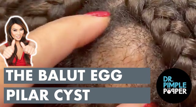 The Balut Egg Pilar Cyst