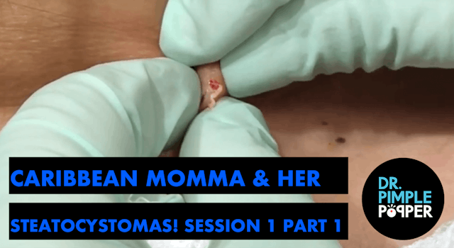 Caribbean Momma & Her Steatocystomas! Session One, Part One