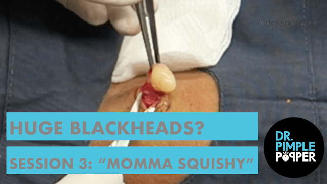 Huge Blackheads?! Session 3 With "Momma Squishy"