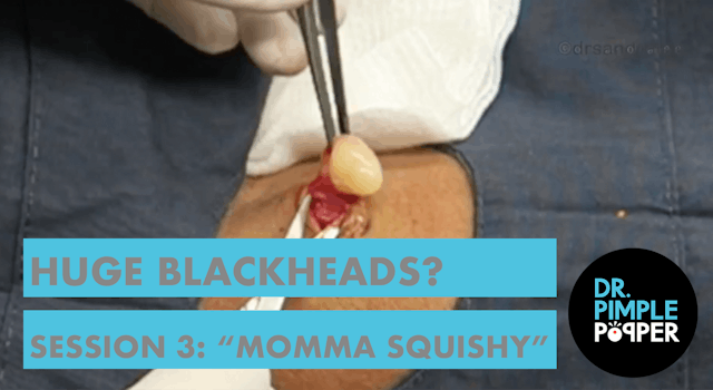 Huge Blackheads?! Session 3 With "Mom...