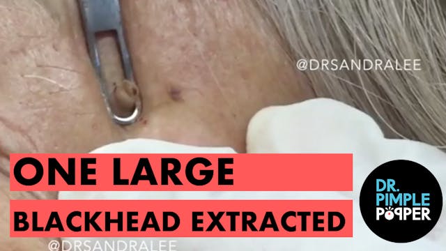 One large blackhead extracted