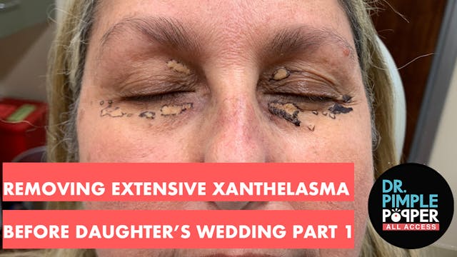 EXCLUSIVE - Removing Extensive Xanthe...