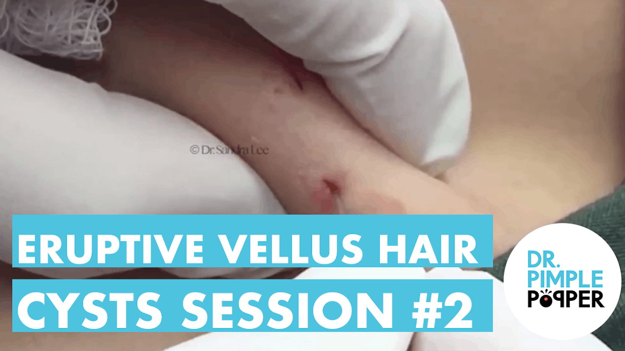 Eruptive Vellus Hair Cysts Session #2 - Dr. Pimple Popper