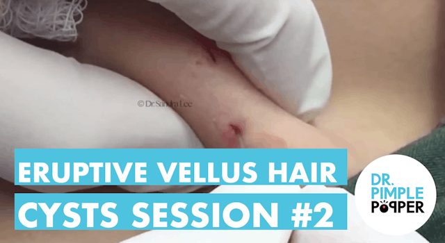 Eruptive Vellus Hair Cysts Session #2