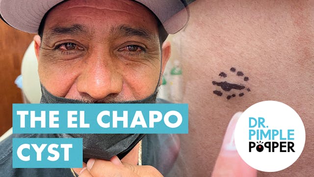 The El Chapo Cyst