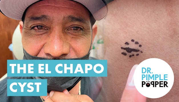 The El Chapo Cyst