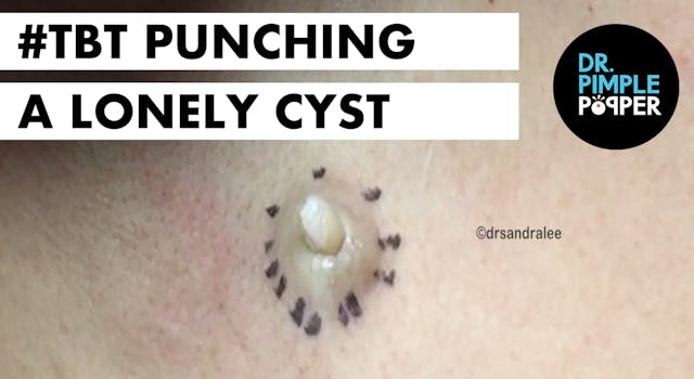 Punching a Lonely Cyst