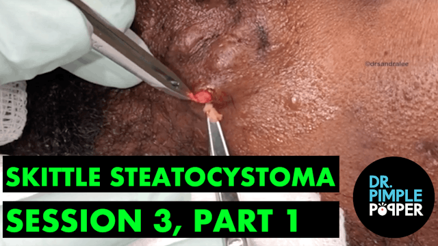 Skittle Steatocystoma Session Three, Part One