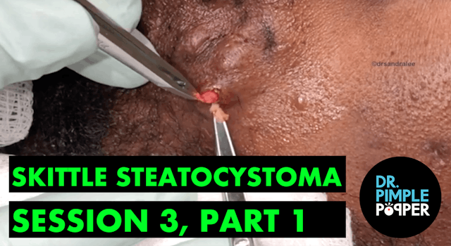 Skittle Steatocystoma Session Three, Part One