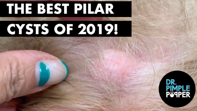 Best Pilar Cysts of 2019!