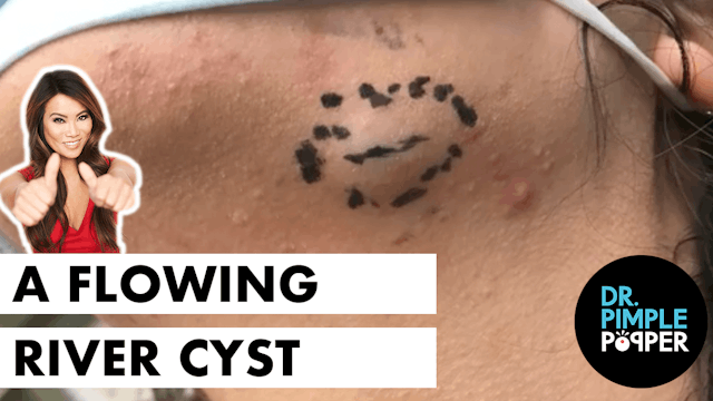 Queen of Pops' Pick: A Flowing River Cyst