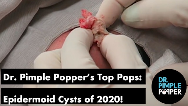 Dr. Pimple Popper's Top Pops of 2020: Epidermoid Cysts!