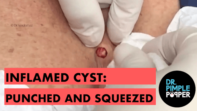 Inflamed Cyst Between the Breasts, Pu...