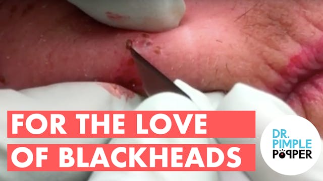 For the LOVE of Blackheads
