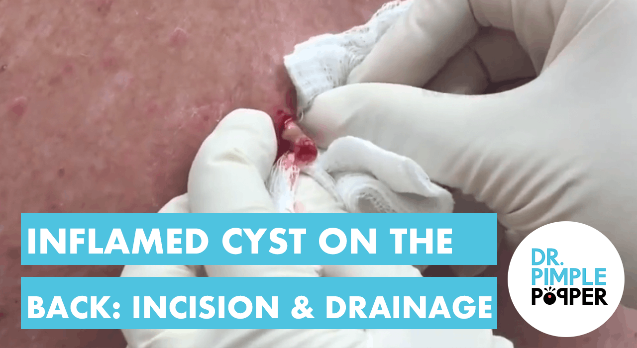 Inflamed cyst on the back: Incision & Drainage. For medical education