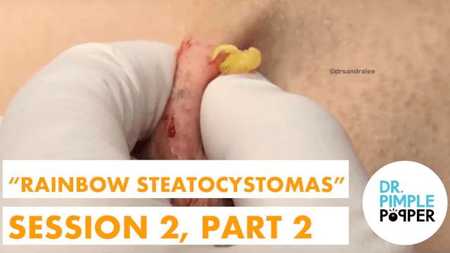 Rainbow Steatocystomas, Session Two, Part Two