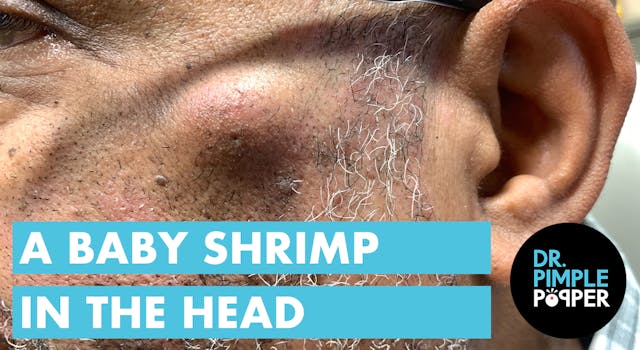 A Baby Shrimp in the Head