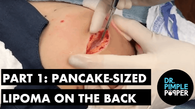 Part 1: A Pancake-Sized Lipoma on the Back with Dr Pimple Popper