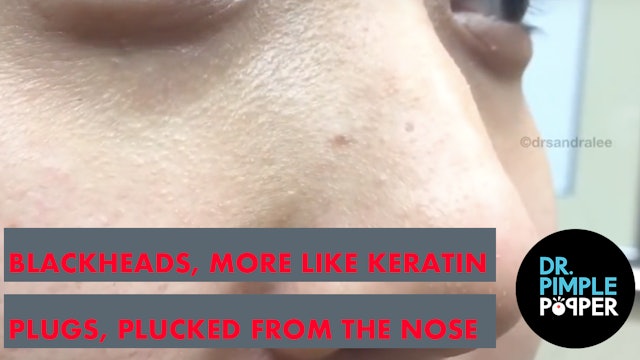 Blackheads, More Like Keratin Plugs