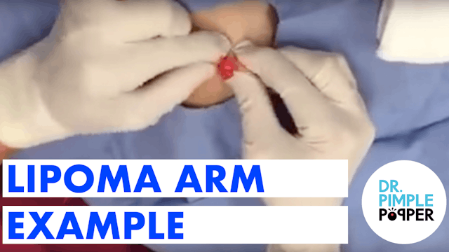 Lipoma Arm Example