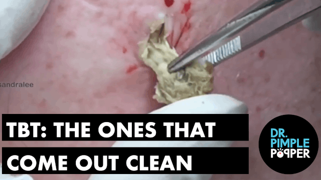 A DrPimplePopper TBT: The ones that come out clean